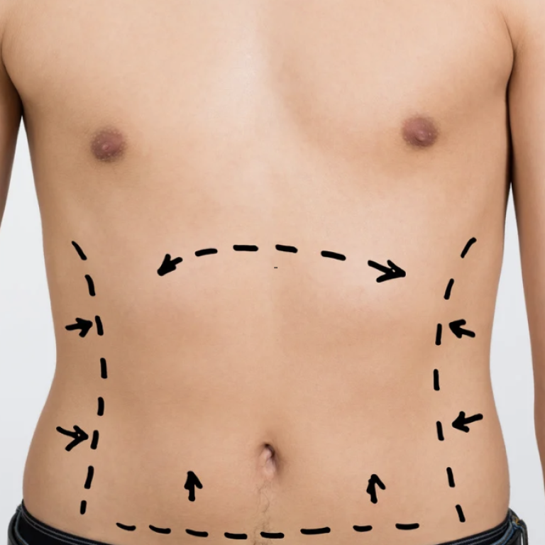 Abdominoplasty in Fairfax Virginia for Excess Skin